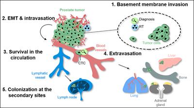 Metastatic Spread in Prostate Cancer Patients Influencing Radiotherapy Response